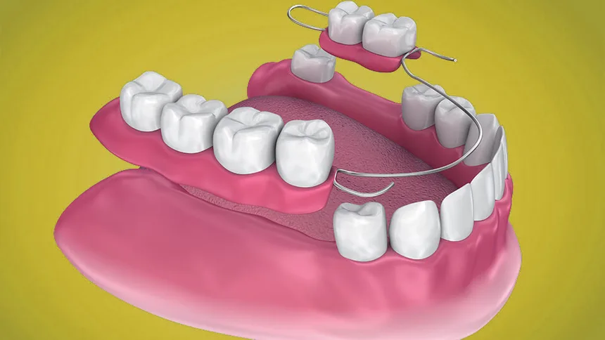 Modelo de implante dental utilizado en los tratamientos de la clínica